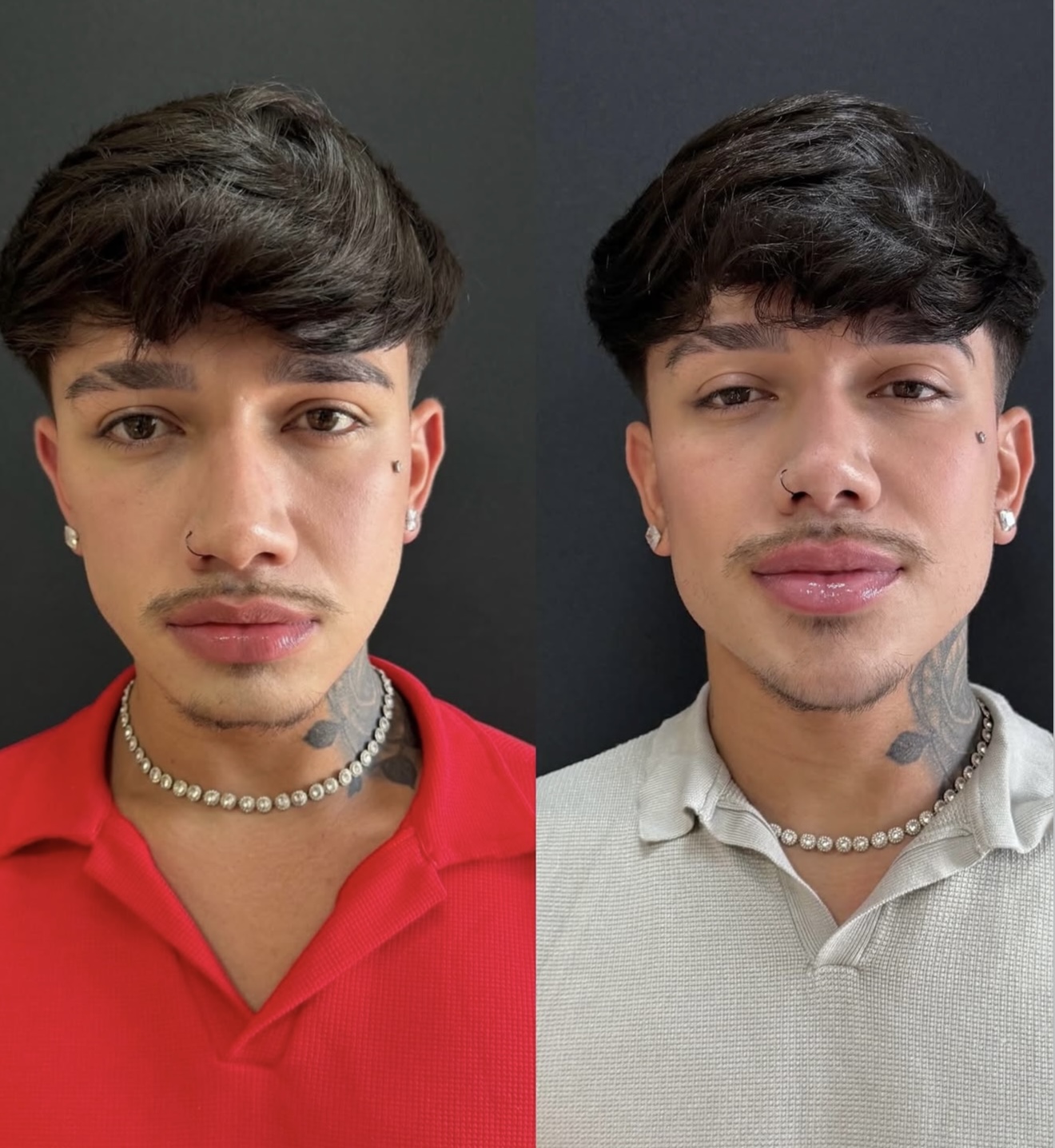 Comparativo facial antes e depois de procedimento estético