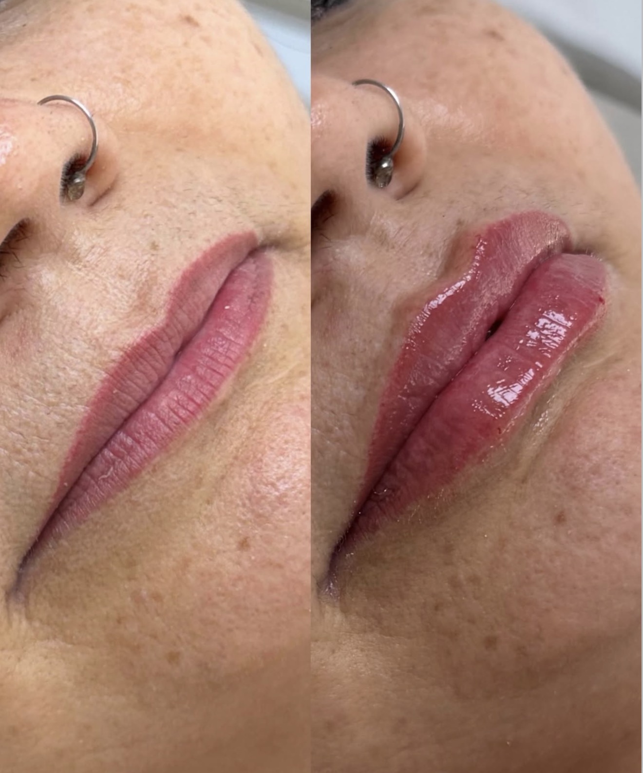 Comparativo antes e depois de procedimento estético facial