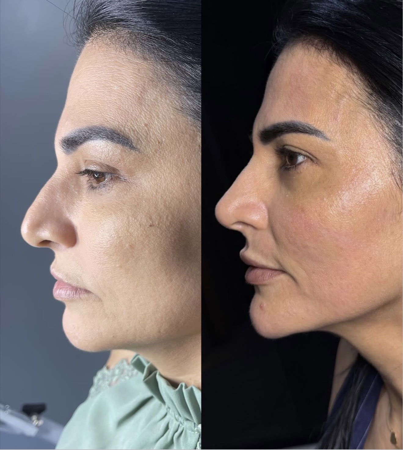 Comparativo antes e depois de procedimento estético facial